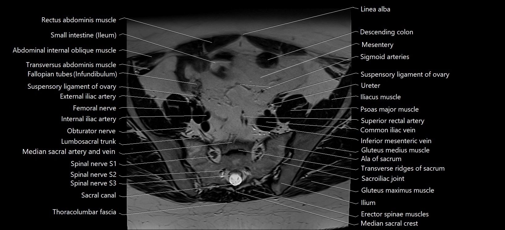 Axial cross sectional anatomy of female pelvis (MRI 3T) image 2.webp
